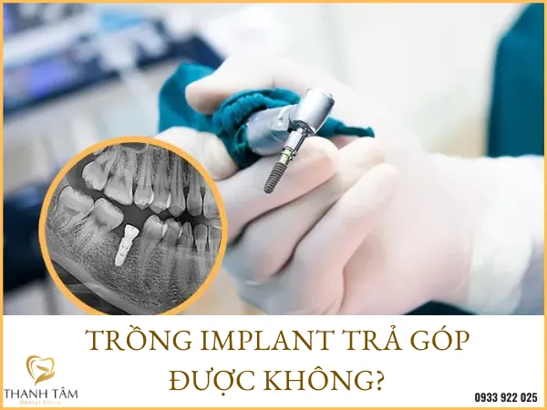 Sản phẩm trong implant tra gop — Công Ty TNHH MTV Khánh An - Nha Khoa Thanh Tâm — MST 0315420625