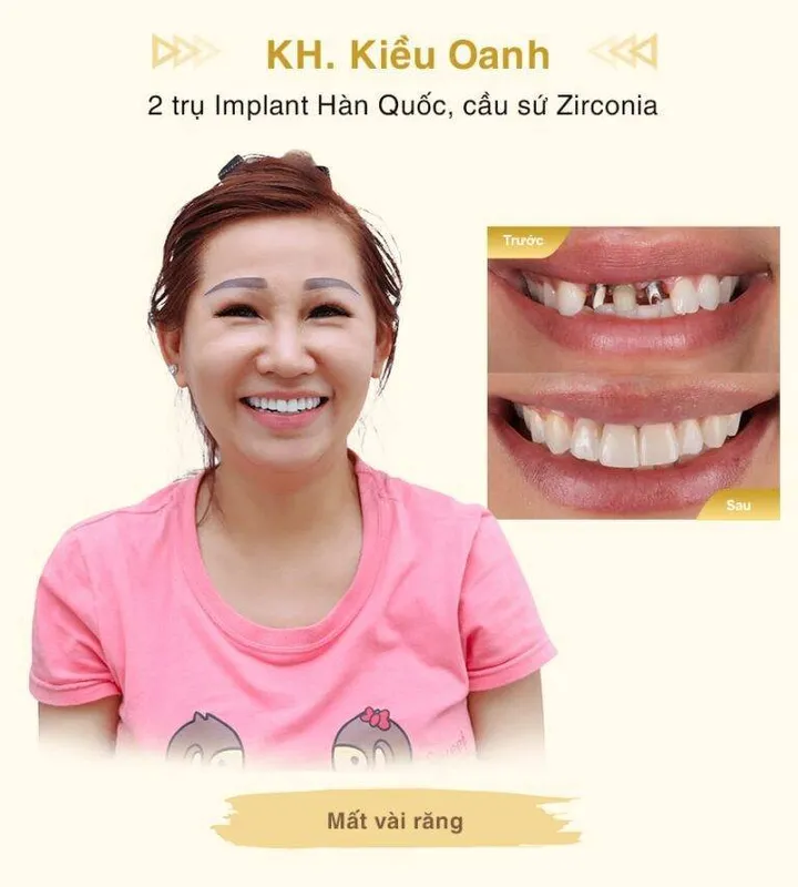 Sản phẩm Implant KH Kieu Oanh mobile min 768x853 1 — Công Ty TNHH MTV Khánh An - Nha Khoa Thanh Tâm — MST 0315420625