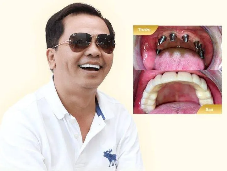 Sản phẩm Implant KH Ngoc Chinh mobile min 1 768x853 1 e1692763756795 — Công Ty TNHH MTV Khánh An - Nha Khoa Thanh Tâm — MST 0315420625