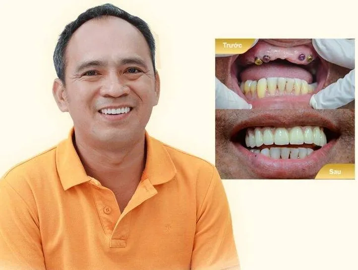 Sản phẩm Implant KH The Vinh mobile min 768x853 1 e1692763814623 — Công Ty TNHH MTV Khánh An - Nha Khoa Thanh Tâm — MST 0315420625
