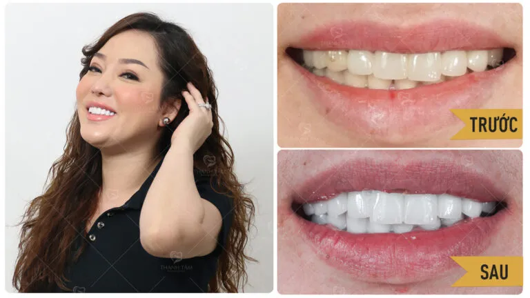 Sản phẩm LE NA BF AT 16X9 768x432 — Công Ty TNHH MTV Khánh An - Nha Khoa Thanh Tâm — MST 0315420625