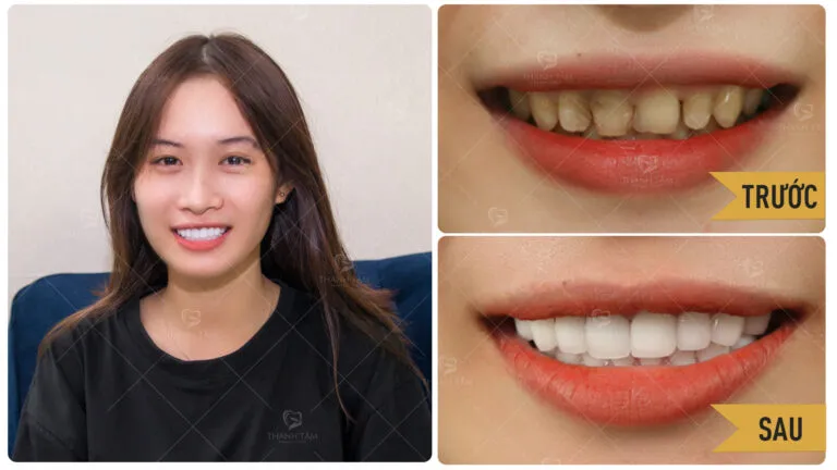 Sản phẩm NGUYEN VO DIEM HANG BF AT 16X9 768x432 — Công Ty TNHH MTV Khánh An - Nha Khoa Thanh Tâm — MST 0315420625