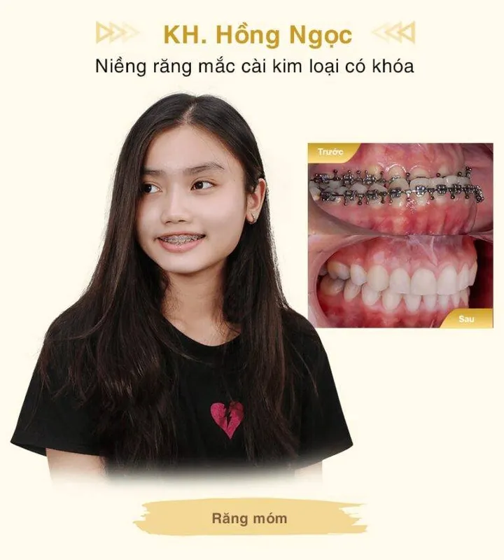Sản phẩm Nieng rang KH Hong Ngoc mobile min 1 768x853 1 — Công Ty TNHH MTV Khánh An - Nha Khoa Thanh Tâm — MST 0315420625