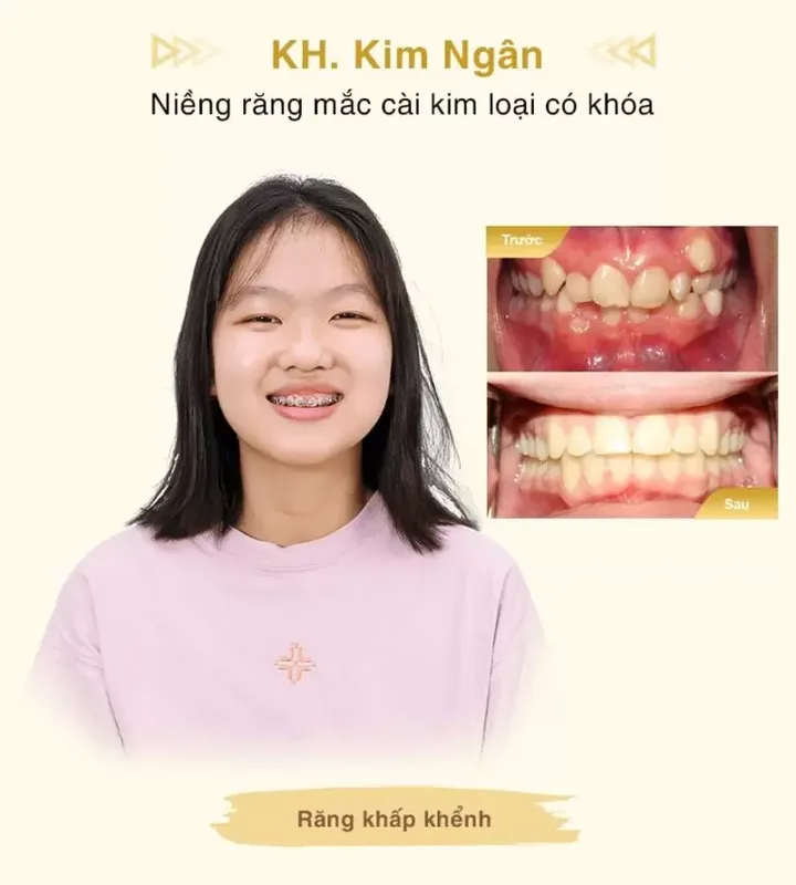 Sản phẩm Nieng rang KH Kim Ngan Mobile min 1 768x853 1 — Công Ty TNHH MTV Khánh An - Nha Khoa Thanh Tâm — MST 0315420625