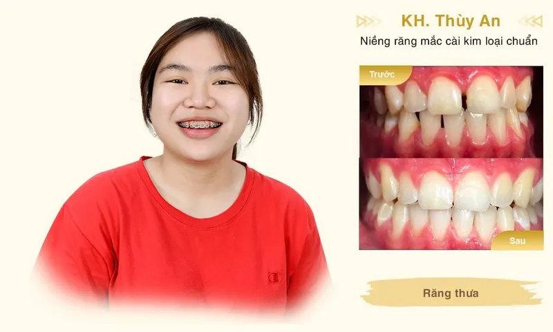 Sản phẩm Nieng rang KH Thuy An desktop min — Công Ty TNHH MTV Khánh An - Nha Khoa Thanh Tâm — MST 0315420625