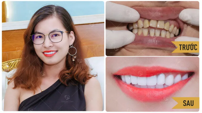 Sản phẩm PHAM HONG PHUONG BF AT 16X9 768x432 — Công Ty TNHH MTV Khánh An - Nha Khoa Thanh Tâm — MST 0315420625