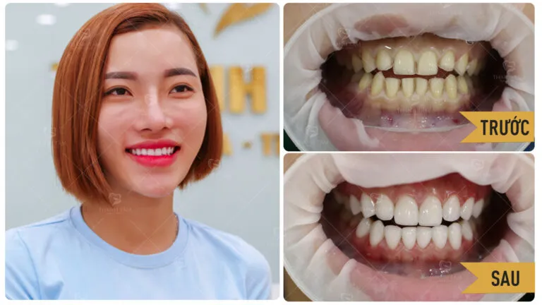 Sản phẩm TRAN THI MY LE BF AT 16X9 768x432 — Công Ty TNHH MTV Khánh An - Nha Khoa Thanh Tâm — MST 0315420625