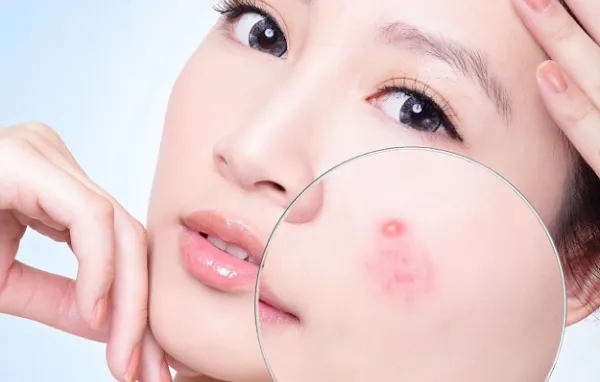 Sản phẩm cach cham soc da mun — Nguyên Liệu Mỹ Phẩm GreenLab - Công Ty TNHH Green Cosmetic Ingredients — MST 0315833781