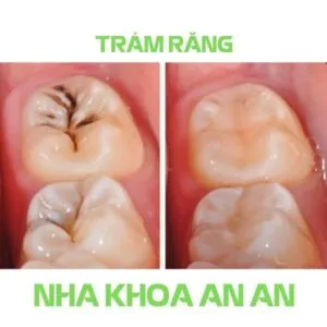 Sản phẩm Tram rang nha khoa an an quan 8 hcm 300x300 — Nha Khoa An An - Công Ty TNHH MT An An — MST 0316426676