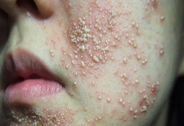 Sản phẩm 1 nguyen nhan khien da nhiem corticoid — Công Ty TNHH TK Cosmetic — MST 0317142733