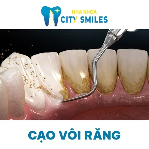 Sản phẩm Cao voi rang — Công Ty Cổ Phần City Smiles — MST 0317541463