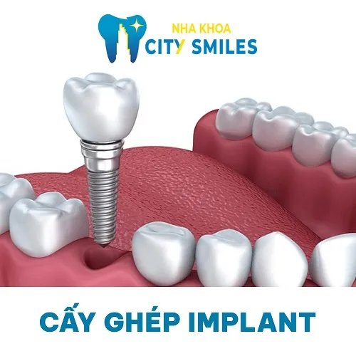 Sản phẩm Trong Rang Implant — Công Ty Cổ Phần City Smiles — MST 0317541463