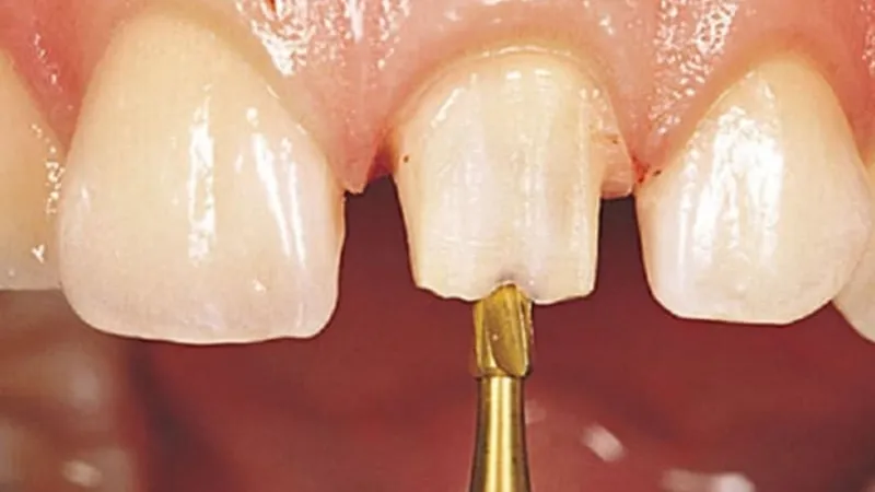 Sản phẩm mai rang la gi co dau khong luu y quan trong de khong anh huong tuy — Công Ty Cổ Phần City Smiles — MST 0317541463