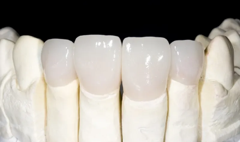 Sản phẩm rang su zirconia la gi uu nhuoc diem va bang gia moi nhat 2026 1 — Công Ty Cổ Phần City Smiles — MST 0317541463