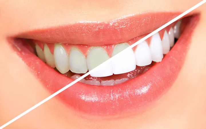 Sản phẩm co nen tay trang rang khong ai phu hop va ai khong nen lam — Công Ty Cổ Phần City Smiles — MST 0317541463
