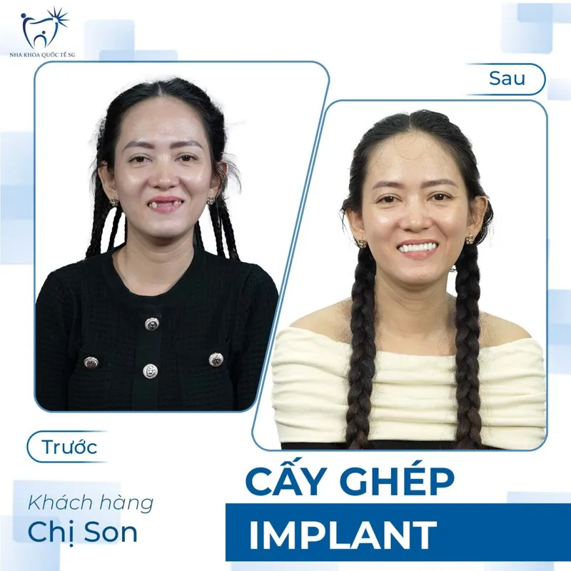 Sản phẩm ketquadieutri1 1200x1200 — Công Ty TNHH Dịch Vụ Nha Khoa Quốc Tế Sài Gòn — MST 0317959356