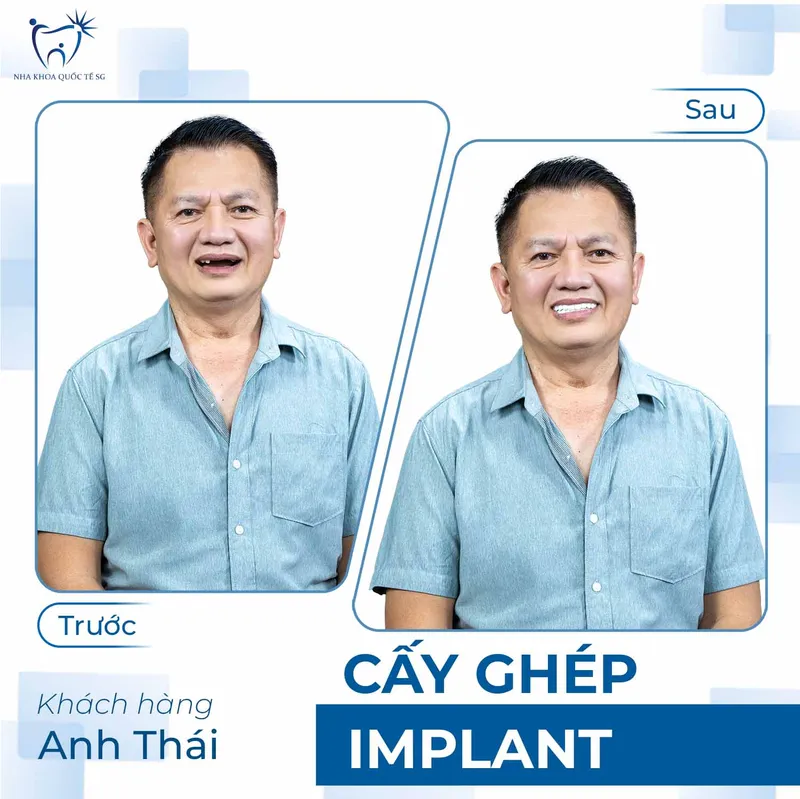 Sản phẩm ketquadieutri2 — Công Ty TNHH Dịch Vụ Nha Khoa Quốc Tế Sài Gòn — MST 0317959356