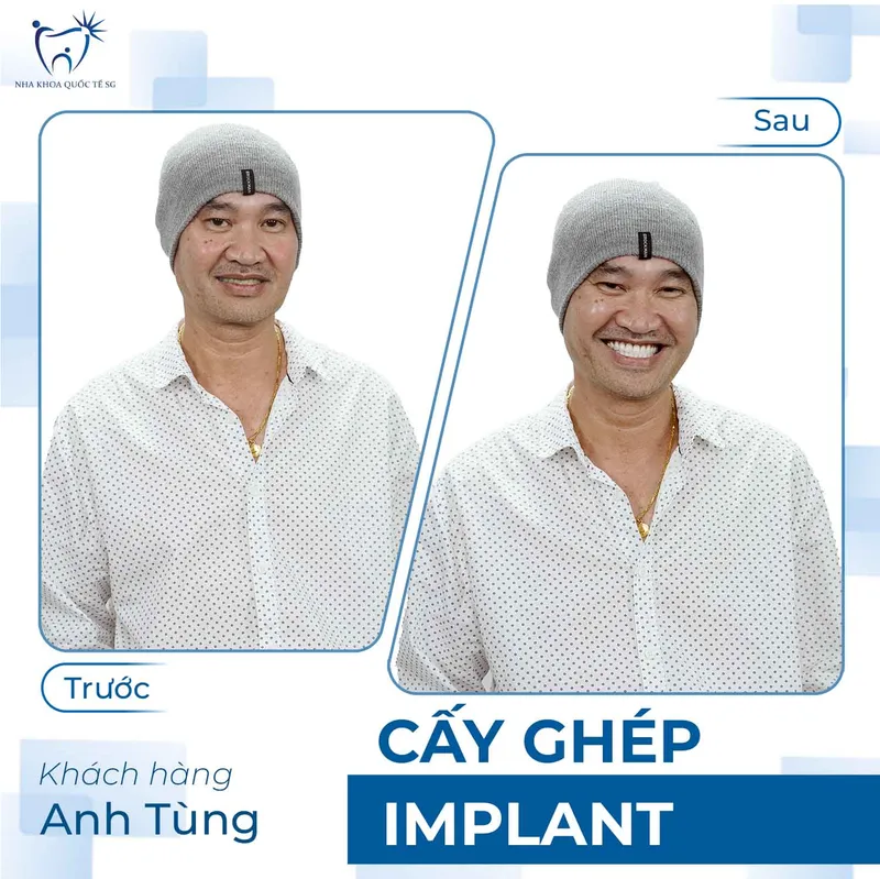 Sản phẩm ketquadieutri3 — Công Ty TNHH Dịch Vụ Nha Khoa Quốc Tế Sài Gòn — MST 0317959356