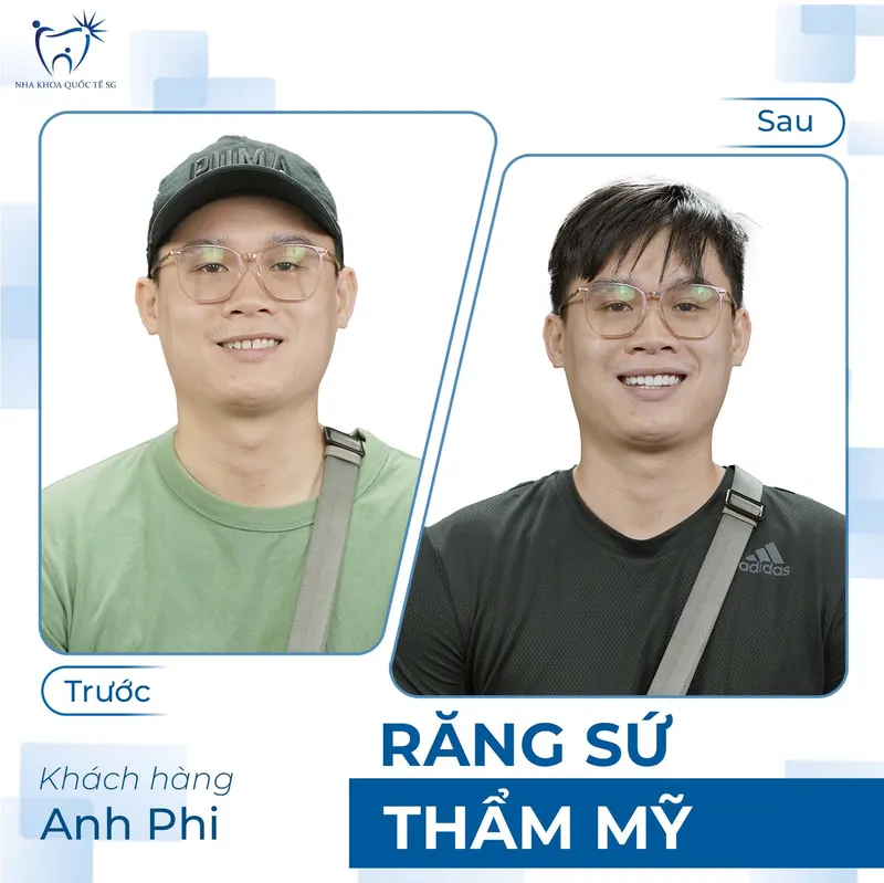 Sản phẩm ketquadieutri4 — Công Ty TNHH Dịch Vụ Nha Khoa Quốc Tế Sài Gòn — MST 0317959356