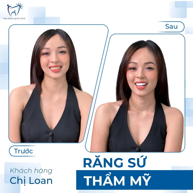 Sản phẩm ketquadieutri5 — Công Ty TNHH Dịch Vụ Nha Khoa Quốc Tế Sài Gòn — MST 0317959356