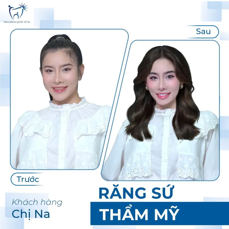 Sản phẩm ketquadieutri6 1200x1200 — Công Ty TNHH Dịch Vụ Nha Khoa Quốc Tế Sài Gòn — MST 0317959356