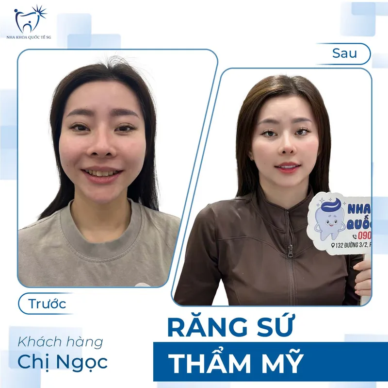 Sản phẩm ketquadieutri7 — Công Ty TNHH Dịch Vụ Nha Khoa Quốc Tế Sài Gòn — MST 0317959356