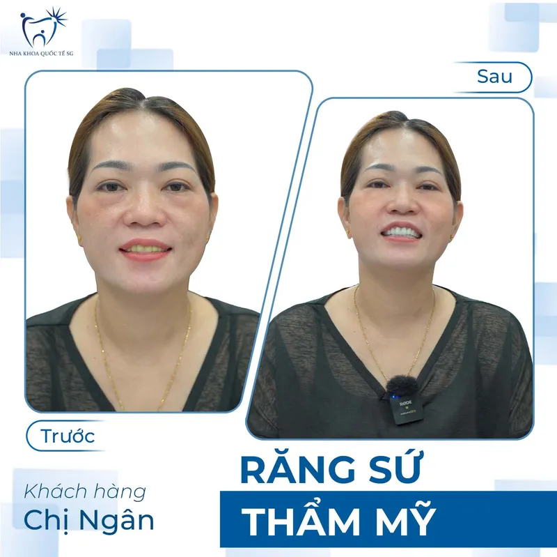 Sản phẩm ketquadieutri8 — Công Ty TNHH Dịch Vụ Nha Khoa Quốc Tế Sài Gòn — MST 0317959356