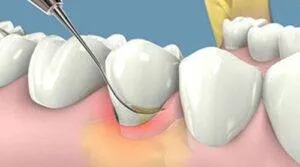 Sản phẩm cao voi rang 300x167 — Nha Khoa Thẩm Mỹ Việt Mỹ - Công Ty TNHH MTV Nha Khoa Thẩm Mỹ Việt Mỹ — MST 0318104307