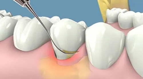 Sản phẩm cao voi rang — Nha Khoa Thẩm Mỹ Việt Mỹ - Công Ty TNHH MTV Nha Khoa Thẩm Mỹ Việt Mỹ — MST 0318104307