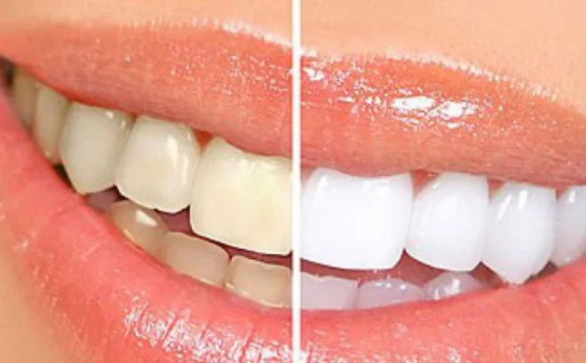 Sản phẩm tay trang rang — Nha Khoa Thẩm Mỹ Việt Mỹ - Công Ty TNHH MTV Nha Khoa Thẩm Mỹ Việt Mỹ — MST 0318104307
