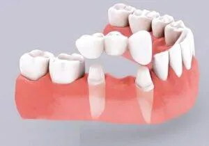 Sản phẩm trong rang 300x210 — Nha Khoa Thẩm Mỹ Việt Mỹ - Công Ty TNHH MTV Nha Khoa Thẩm Mỹ Việt Mỹ — MST 0318104307