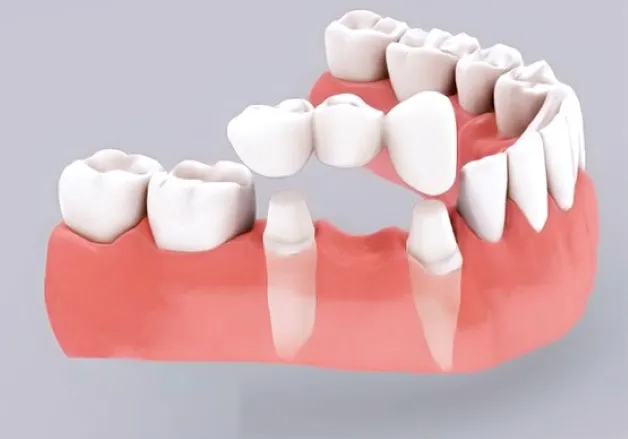 Sản phẩm trong rang — Nha Khoa Thẩm Mỹ Việt Mỹ - Công Ty TNHH MTV Nha Khoa Thẩm Mỹ Việt Mỹ — MST 0318104307