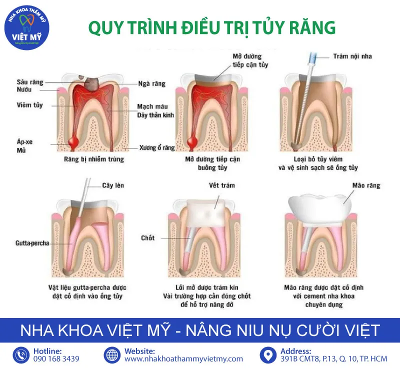 Sản phẩm nha khoa viet my chi phi lay tuy va boc rang su gia bao nhieu final — Nha Khoa Thẩm Mỹ Việt Mỹ - Công Ty TNHH MTV Nha Khoa Thẩm Mỹ Việt Mỹ — MST 0318104307