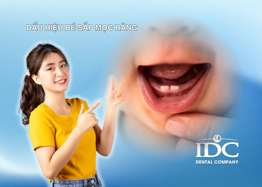 Sản phẩm dau hieu be sap moc rang — Nha Khoa IDC Danang - Công Ty TNHH MTV Nha Khoa Quốc Tế — MST 0401307133