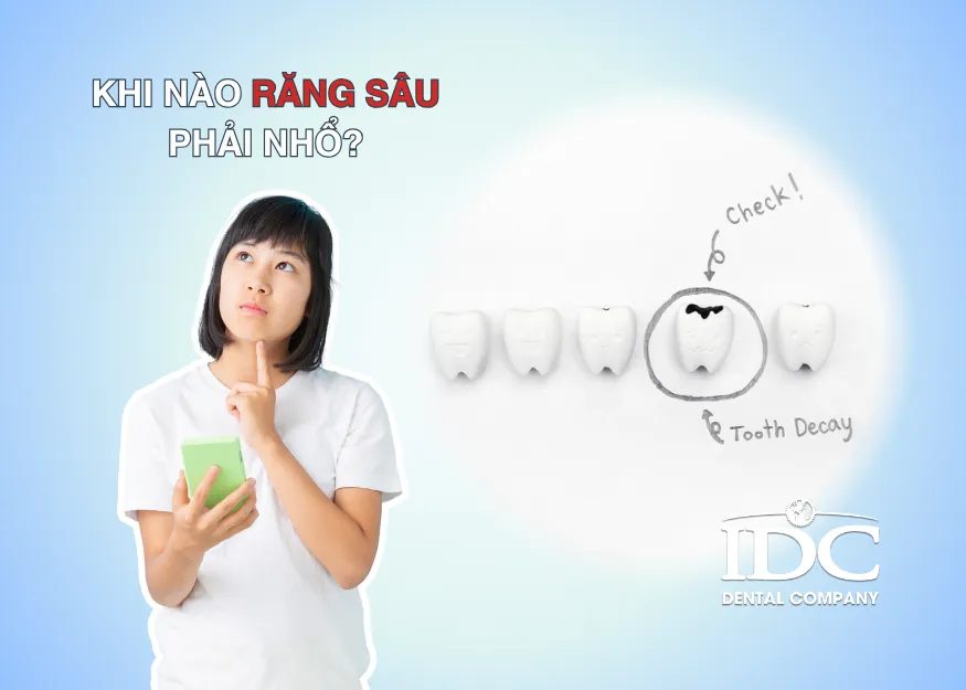 Sản phẩm khi nao rang sau can phai nho — Nha Khoa IDC Danang - Công Ty TNHH MTV Nha Khoa Quốc Tế — MST 0401307133