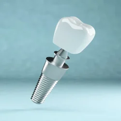 Sản phẩm trong rang implant_8_11zon rf5qdpmnatag7nh8vifoddrb0c3skrmpbqkb64x9vo — Nha Khoa IDC Danang - Công Ty TNHH MTV Nha Khoa Quốc Tế — MST 0401307133