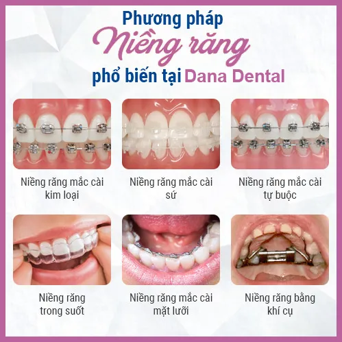Sản phẩm nieng rang tai dana dental nha khoa da nang — Công Ty TNHH Nha Khoa Dana — MST 0402161656