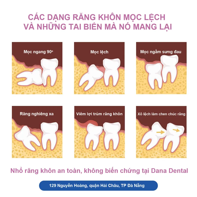 Sản phẩm rang khon moc lech can phai nho bo — Công Ty TNHH Nha Khoa Dana — MST 0402161656