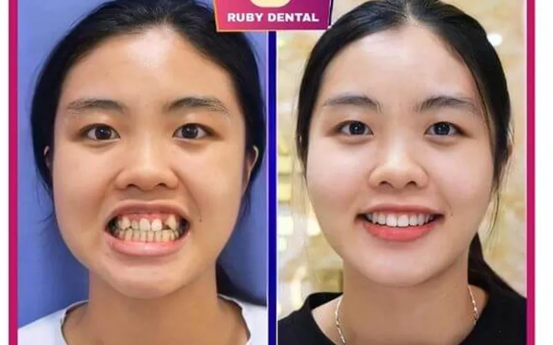 Sản phẩm Khach hang 9 — Công Ty TNHH RUBY DENTAL — MST 1001223924