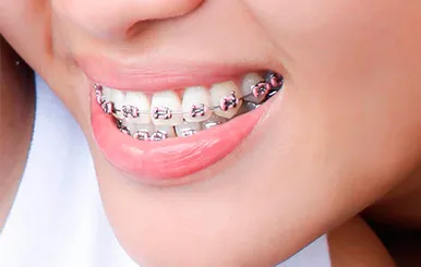 Sản phẩm Nieng rang — Công Ty TNHH RUBY DENTAL — MST 1001223924