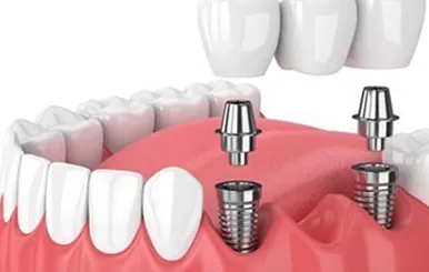 Sản phẩm Trong rang iplant — Công Ty TNHH RUBY DENTAL — MST 1001223924