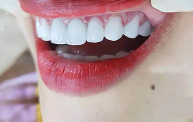 Sản phẩm boc rang su — Công Ty TNHH RUBY DENTAL — MST 1001223924