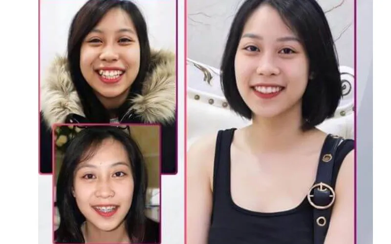 Sản phẩm khach hang 01 — Công Ty TNHH RUBY DENTAL — MST 1001223924
