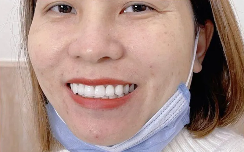 Sản phẩm khach hang 11 — Công Ty TNHH RUBY DENTAL — MST 1001223924