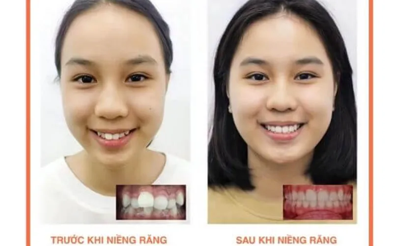 Sản phẩm khach hang 4 — Công Ty TNHH RUBY DENTAL — MST 1001223924