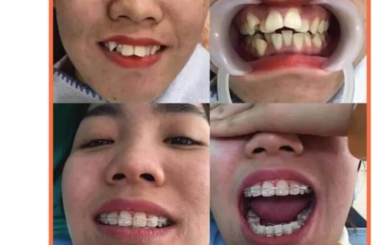 Sản phẩm khach hang 5 — Công Ty TNHH RUBY DENTAL — MST 1001223924