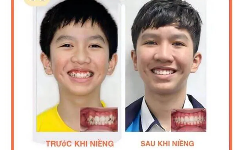 Sản phẩm khach hang 6 — Công Ty TNHH RUBY DENTAL — MST 1001223924