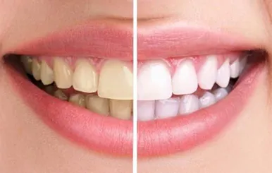 Sản phẩm tay trang rang — Công Ty TNHH RUBY DENTAL — MST 1001223924
