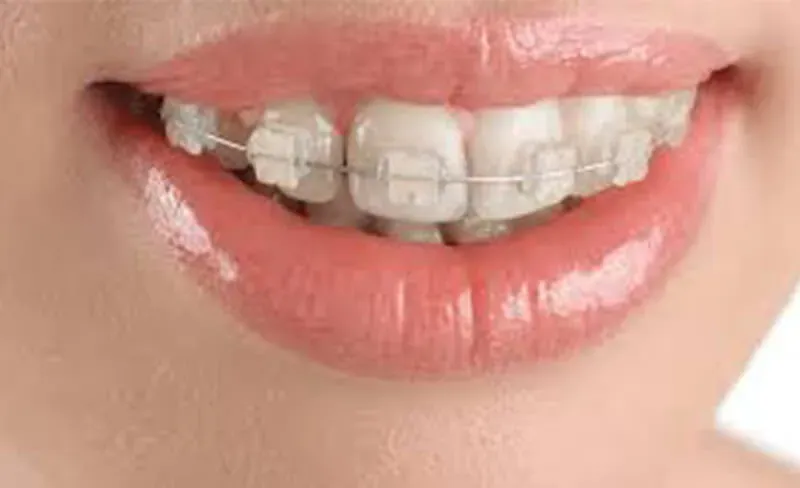 Sản phẩm nieng rang 1 ham — Công Ty TNHH RUBY DENTAL — MST 1001223924