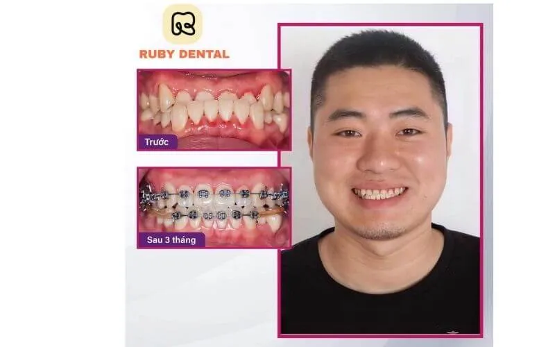 Sản phẩm 20 — Công Ty TNHH RUBY DENTAL — MST 1001223924